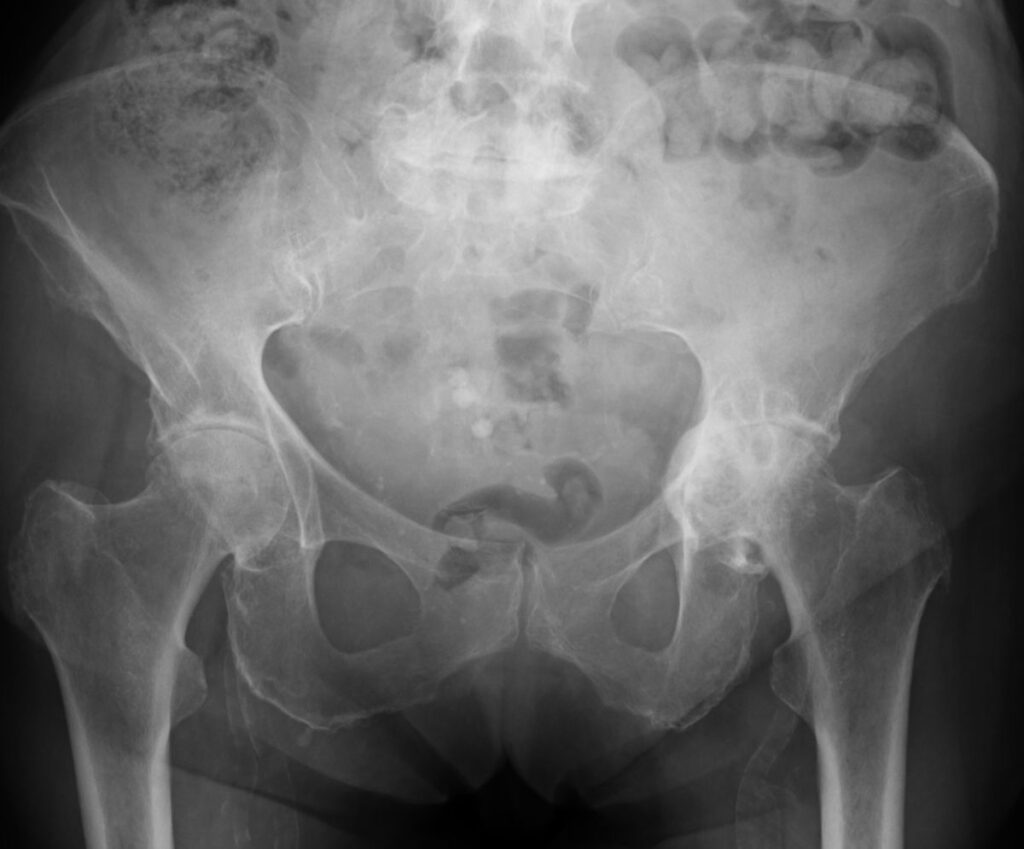 Hüftarthrose und die Behandlung durch Physiotherapie: Ein Weg zu mehr Lebensqualität